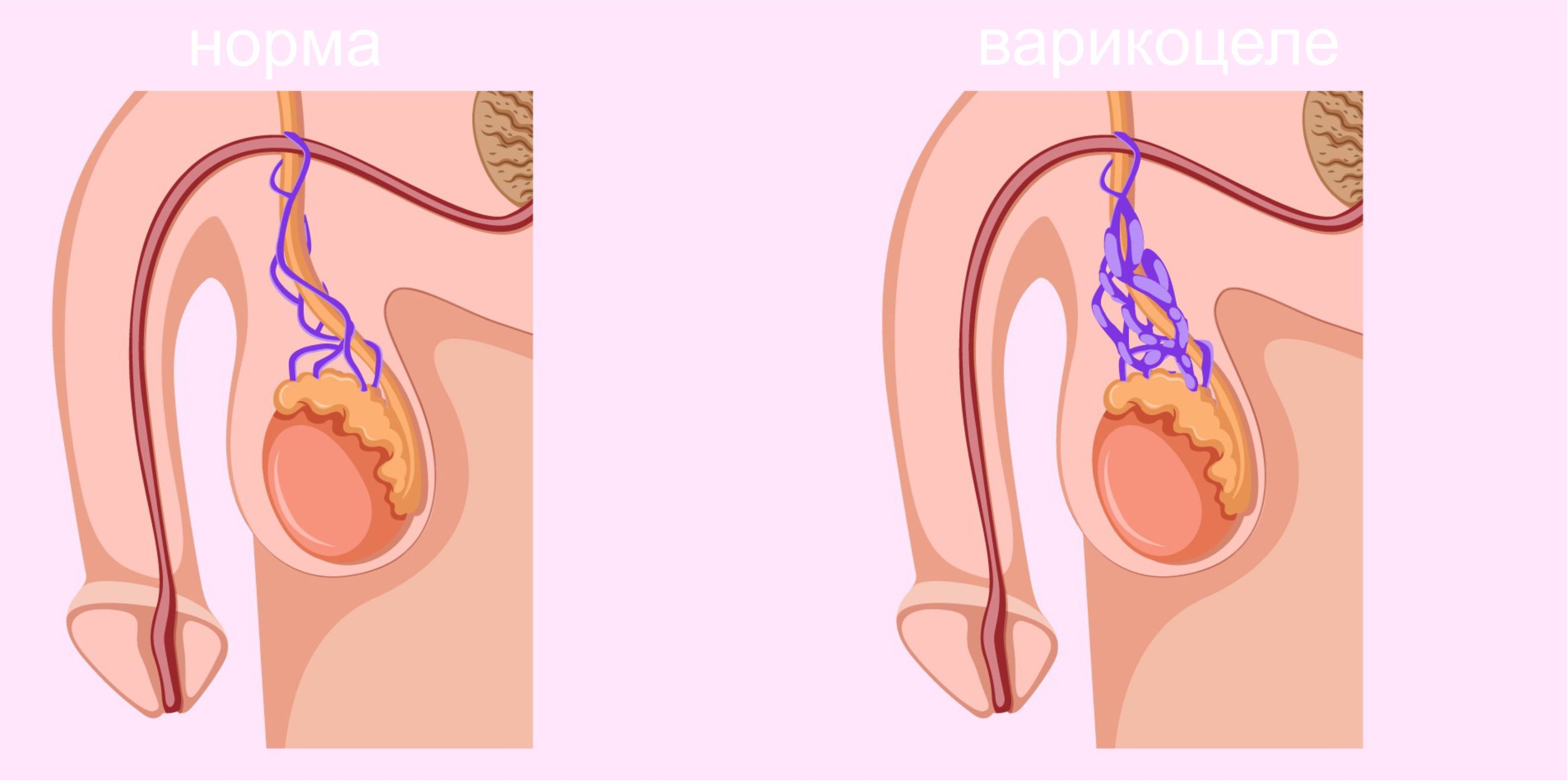 Варикоцеле - Минск