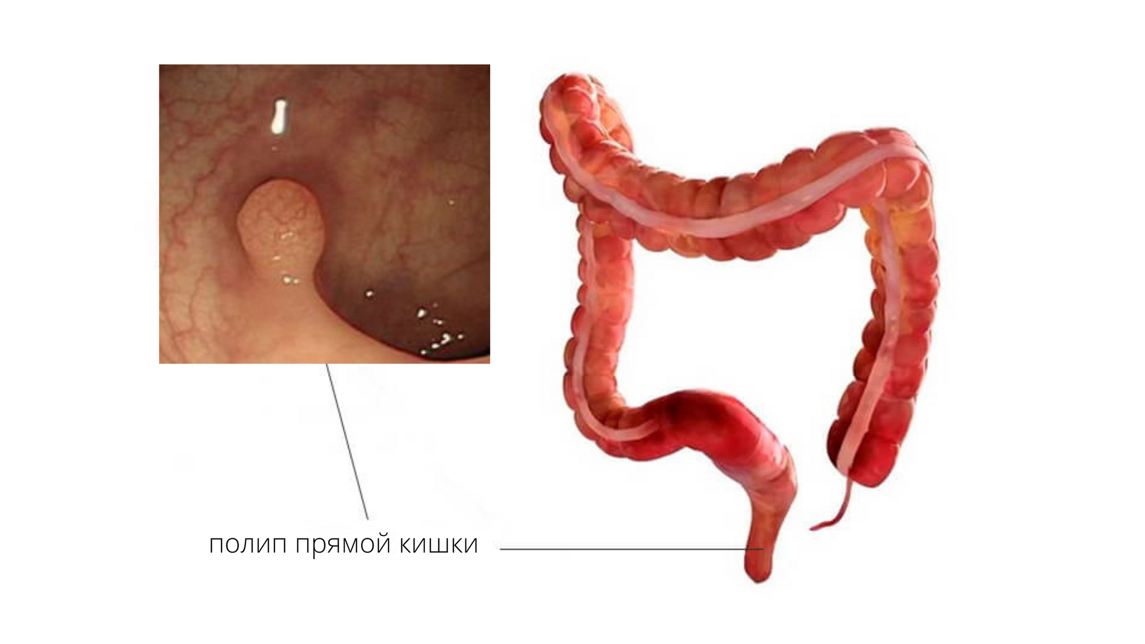 Полипы прямой кишки